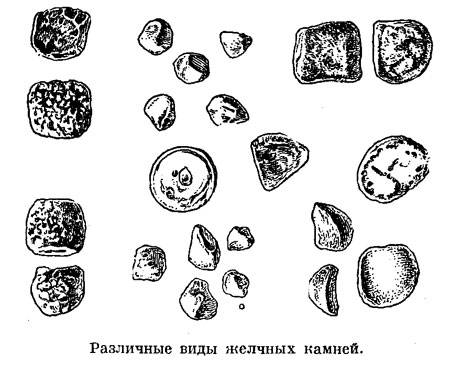 Различные виды желчных камней