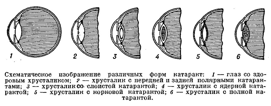 Схематическое изображение различных форм катаракт