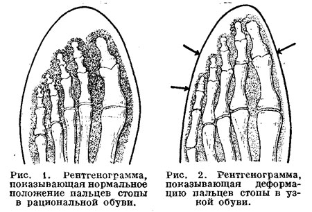 Рентгенограмма показывающая деформацию пальцев стопы в узкой обуви