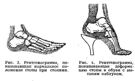 Рентгенограмма показывающая деформацию пальцев стопы в обуви с высоким каблуком