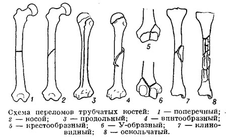 Схемы переломов трубчатых костей